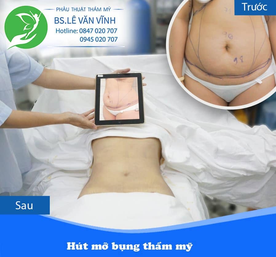 Kết quả hút mỡ bụng- về dáng nhanh hơn trên cùng một lộ trình