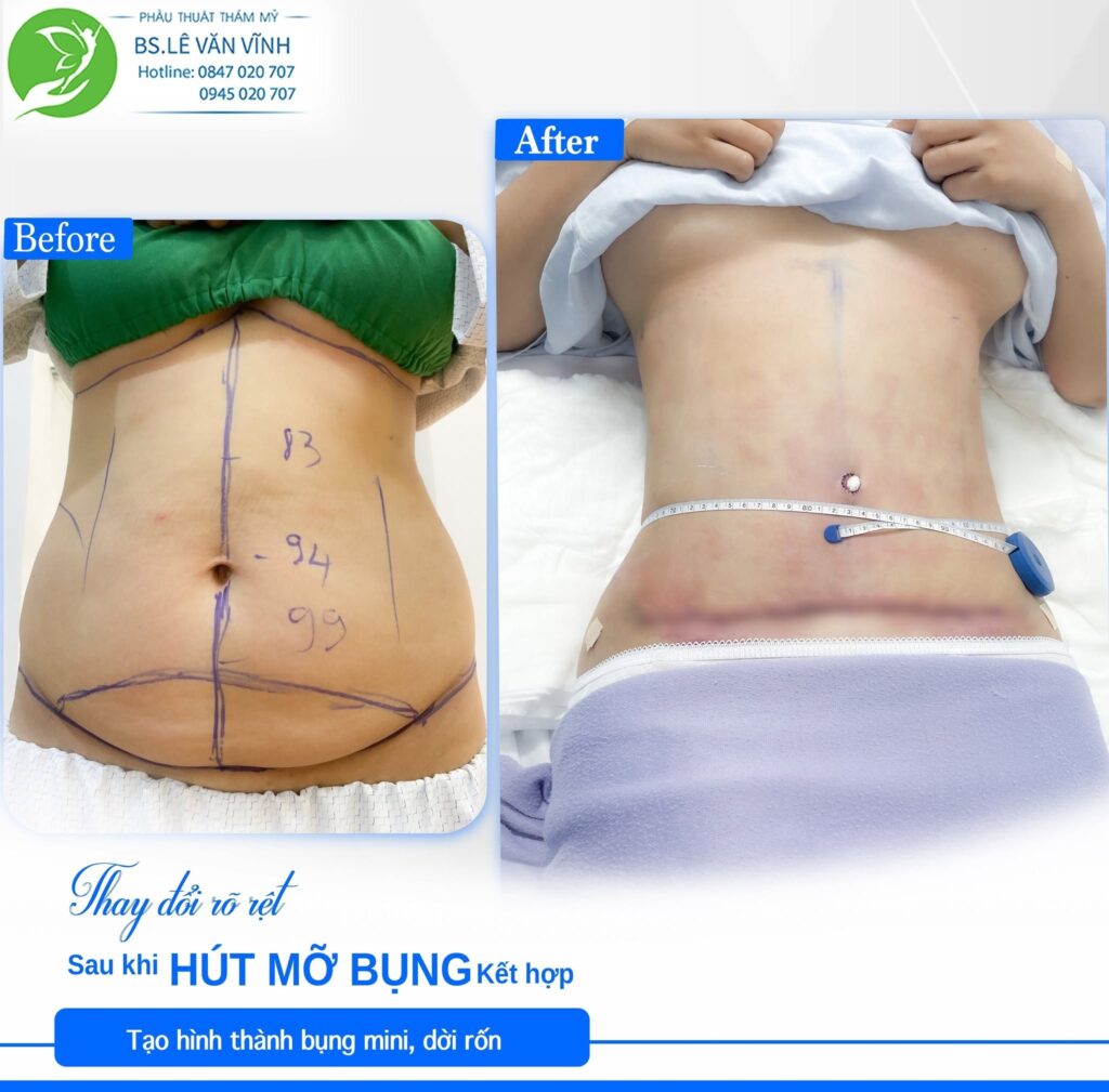 Kết quả hút mỡ bụng- về dáng nhanh hơn trên cùng một lộ trình
