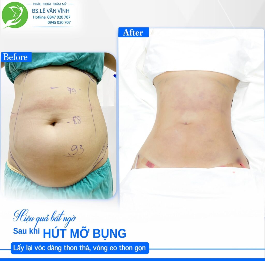 Kết quả hút mỡ bụng- Về dáng nhanh hơn trên cùng một lộ trình