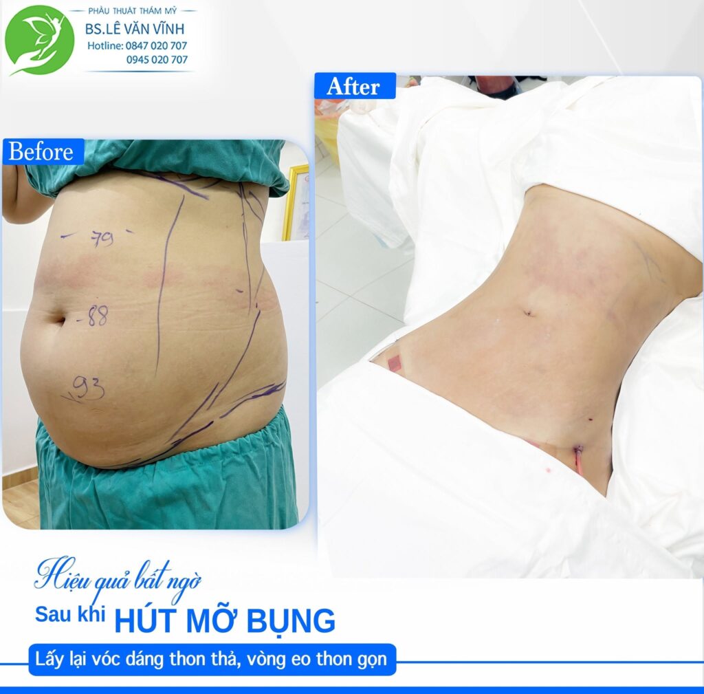 Kết quả hút mỡ bụng- về dáng nhanh hơn trên cùng một lộ trình