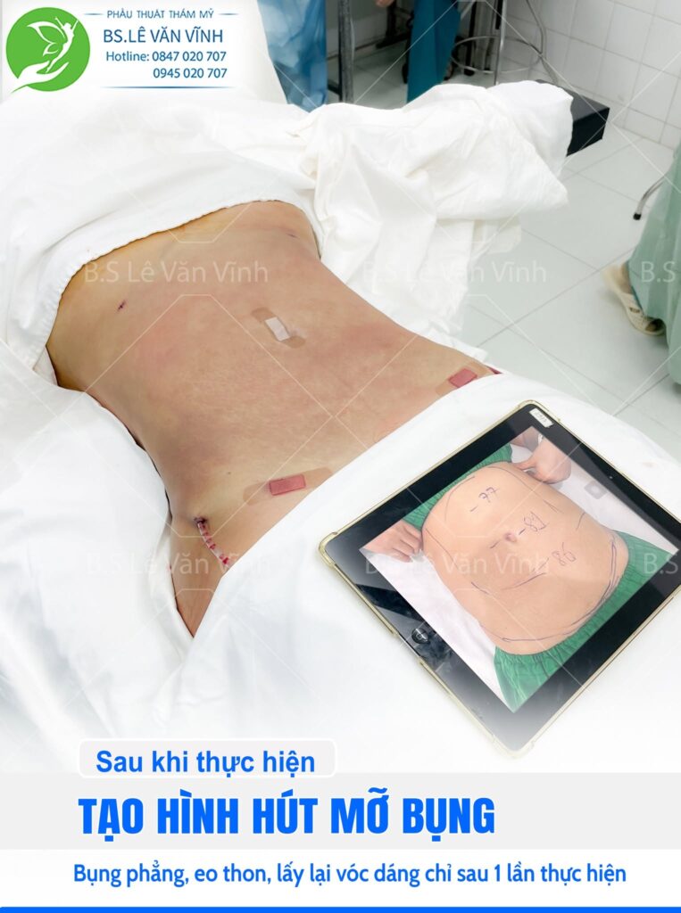 Kết quả hút mỡ bụng- về dáng nhanh hơn trên cùng một lộ trình