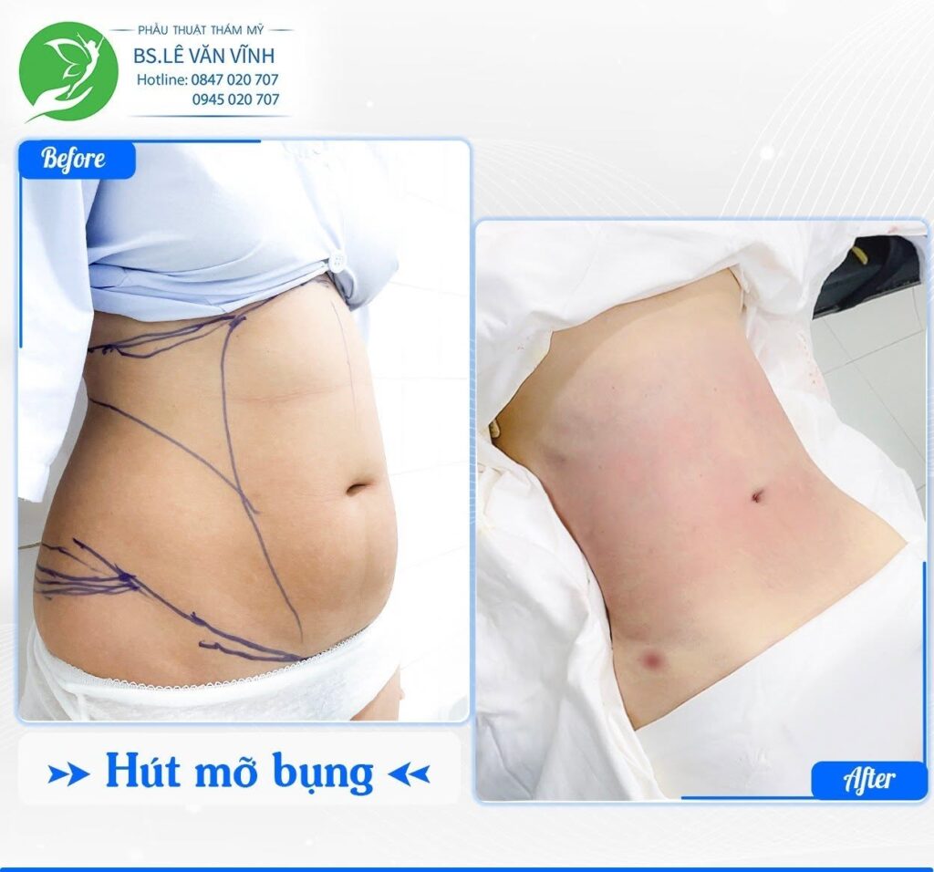 Kết quả hút mỡ bụng- về dáng nhanh hơn trên cùng một lộ trình