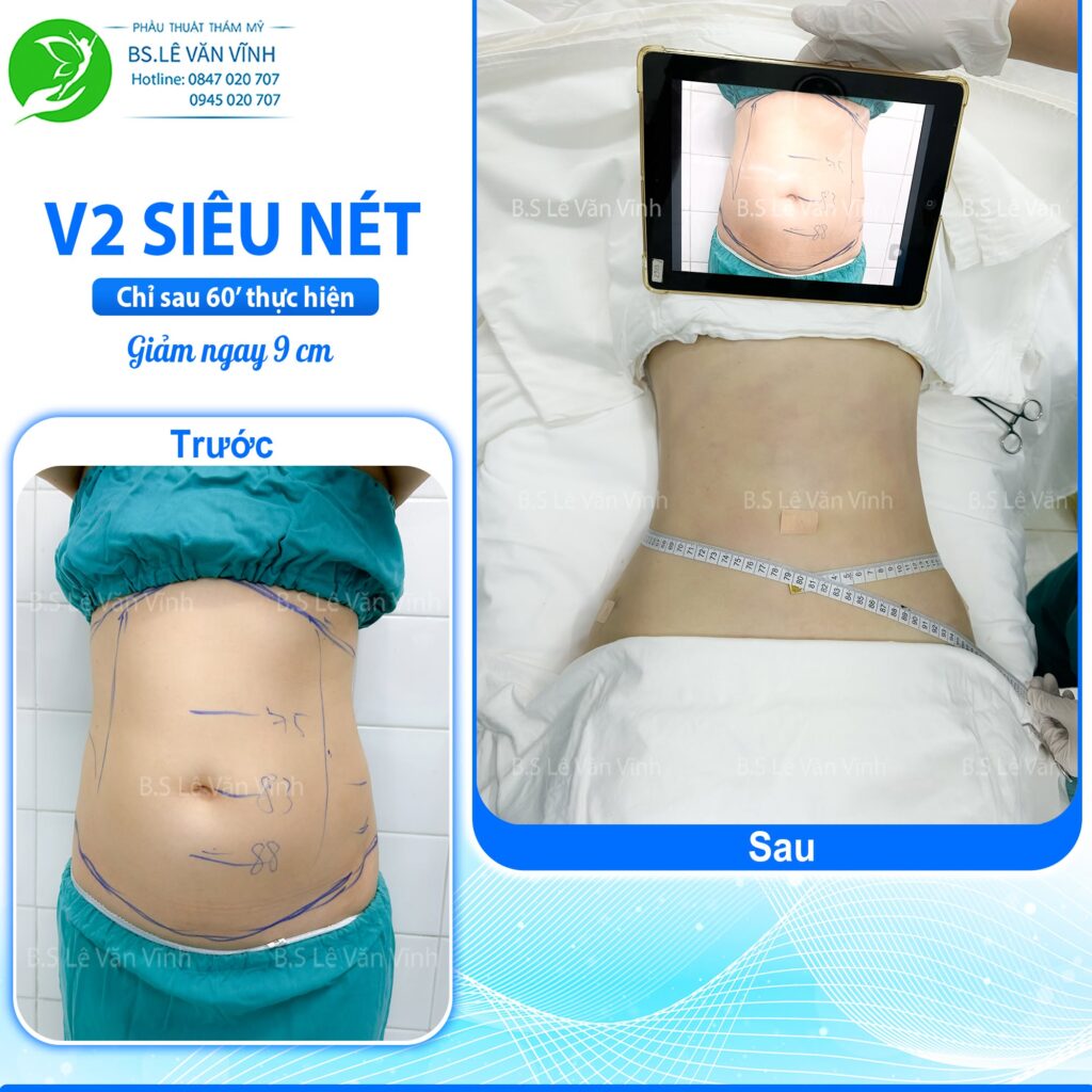 Kết quả hút mỡ bụng- Về dáng nhanh hơn trên cùng một lộ trình.