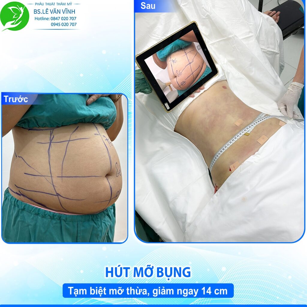 Kết quả hút mỡ bụng- Về dáng nhanh hơn trên cùng một lộ trình.