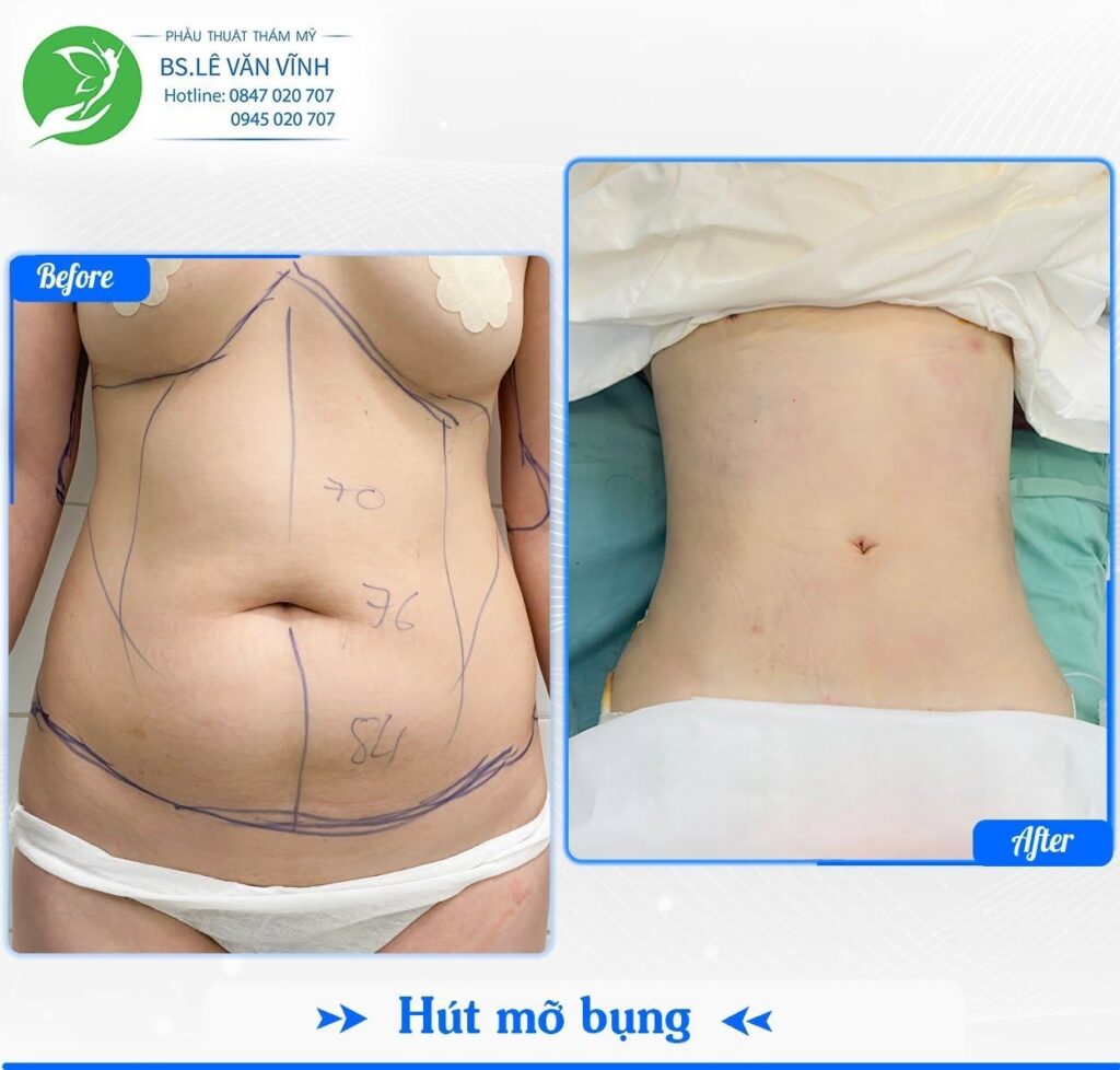 Kết quả hút mỡ bụng- Về dáng nhanh hơn trên cùng một lộ trình