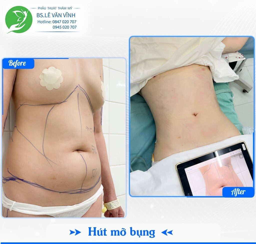 Kết quả hút mỡ bụng- Về dáng nhanh hơn trên cùng một lộ trình