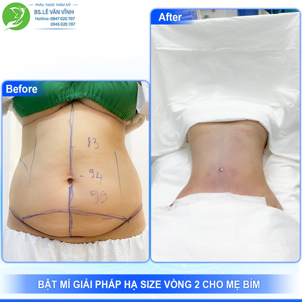 Kết quả hút mỡ bụng- về dáng nhanh hơn trên cùng một lộ trình