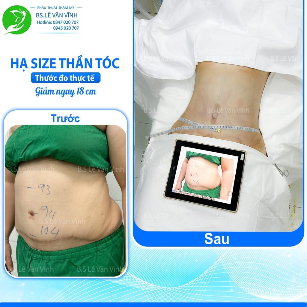 Kết quả hút mỡ bụng- về dáng nhanh hơn trên cùng một lộ trình