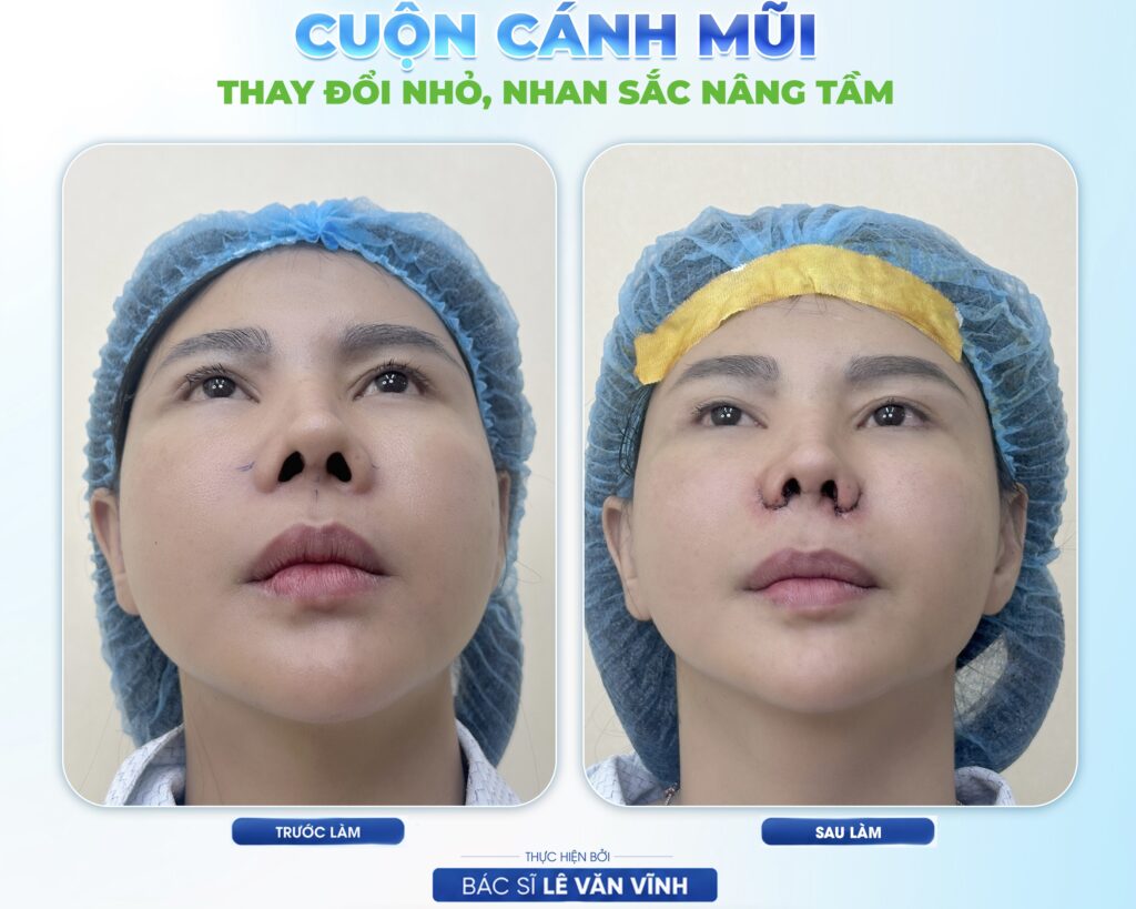 Cuộn cánh mũi do Bác sĩ Lê Văn Vĩnh thực hiện