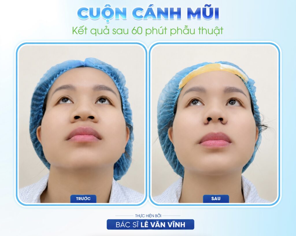 Cuộn cánh mũi do Bác sĩ Lê Văn Vĩnh thực hiện