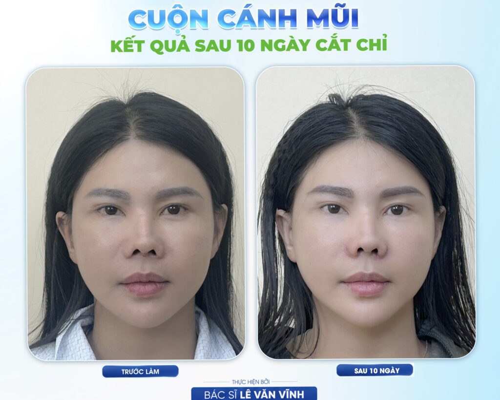 Cuộn cánh mũi do Bác sĩ Lê Văn Vĩnh thực hiện