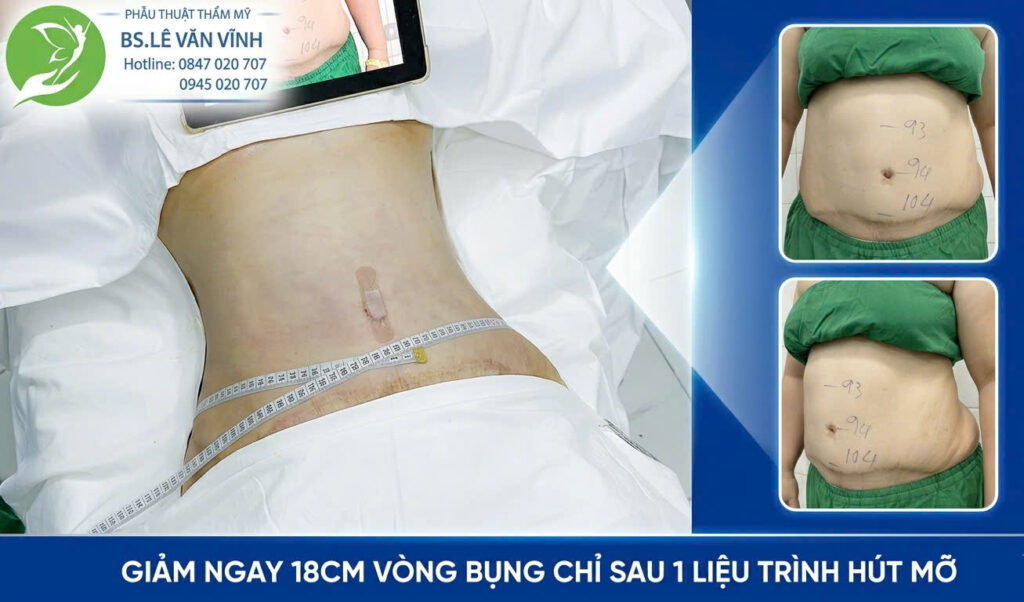 Kết quả hút mỡ bụng- Về dáng nhanh hơn trên cùng một lộ trình.
