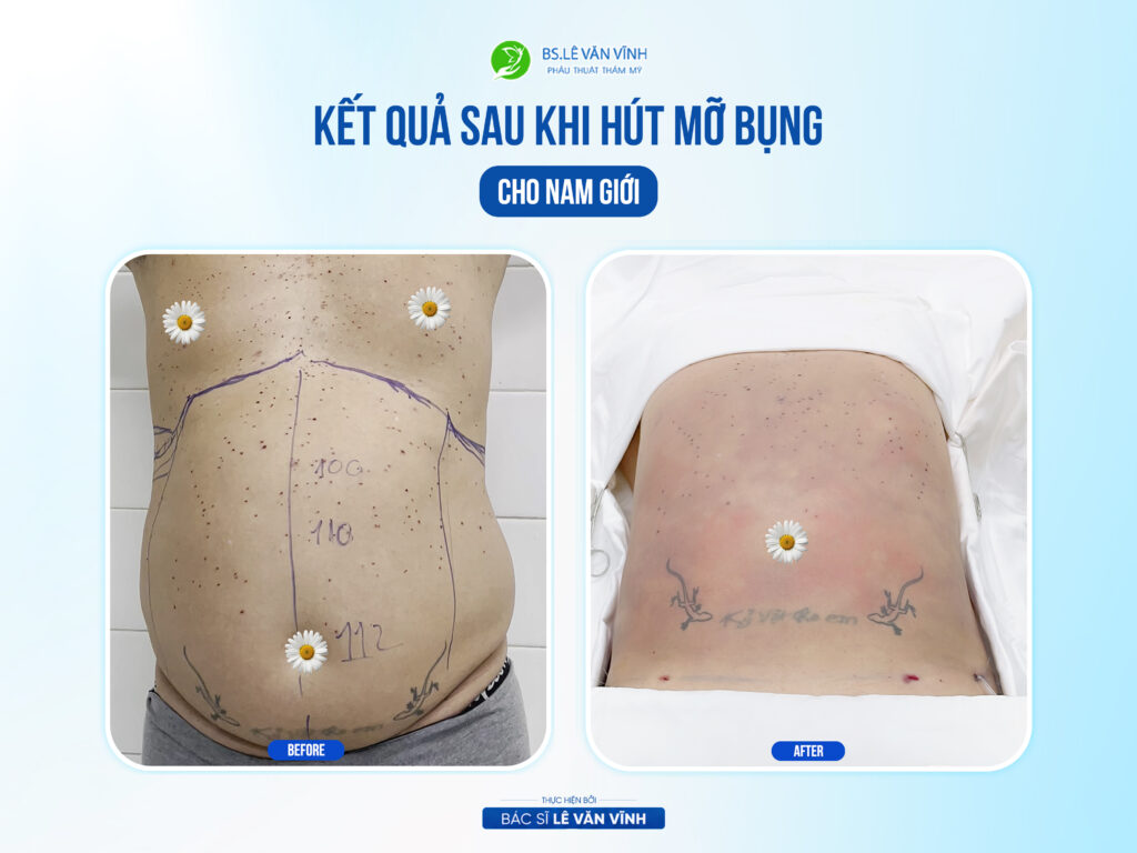 Kết quả hút mỡ bụng- Về dáng nhanh hơn trên cùng một lộ trình.