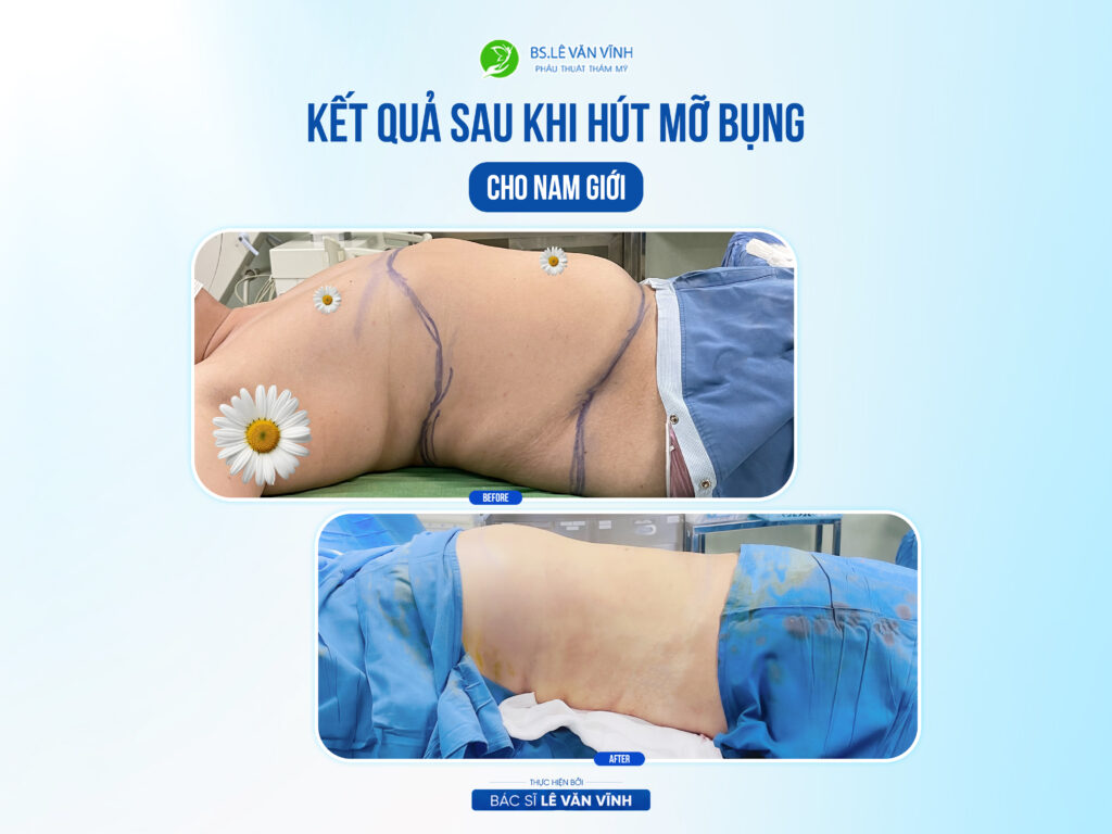 Kết quả hút mỡ bụng- Về dáng nhanh hơn trên cùng một lộ trình.
