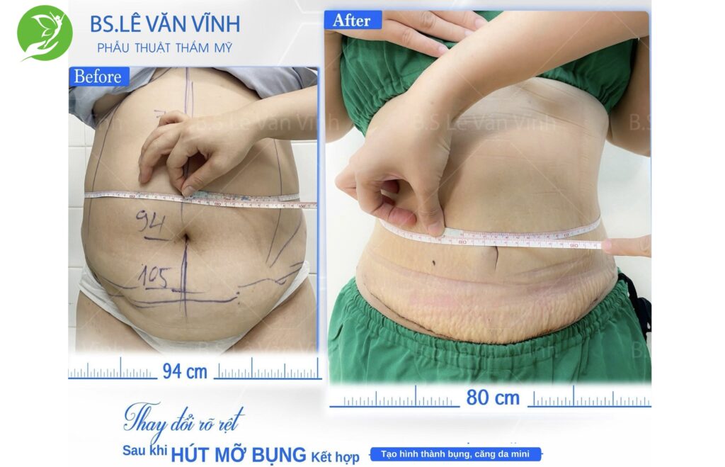 Kết quả hút mỡ bụng- Về dáng nhanh hơn trên cùng một lộ trình.