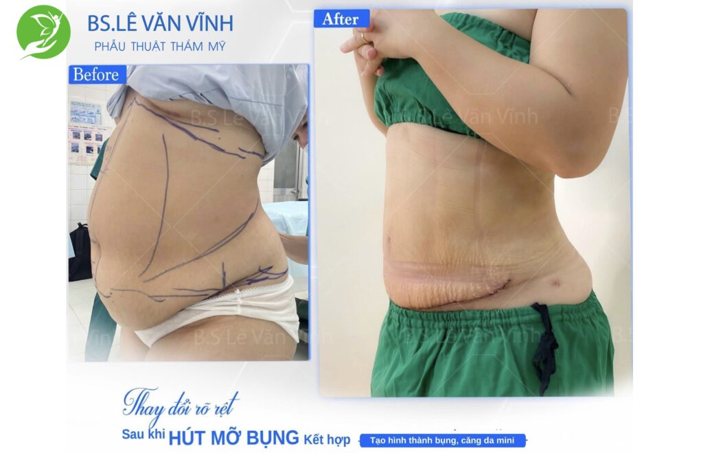 Kết quả hút mỡ bụng- Về dáng nhanh hơn trên cùng một lộ trình.