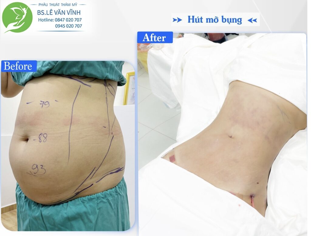 Kết quả hút mỡ bụng- Về dáng nhanh hơn trên cùng một lộ trình.