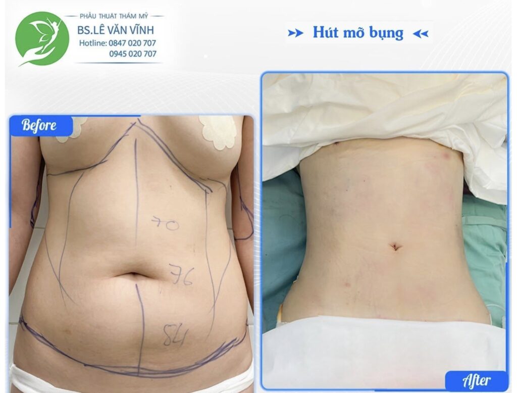 Kết quả hút mỡ bụng- Về dáng nhanh hơn trên cùng một lộ trình.