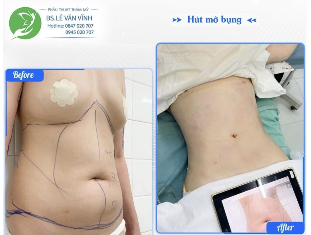 Kết quả hút mỡ bụng- Về dáng nhanh hơn trên cùng một lộ trình.