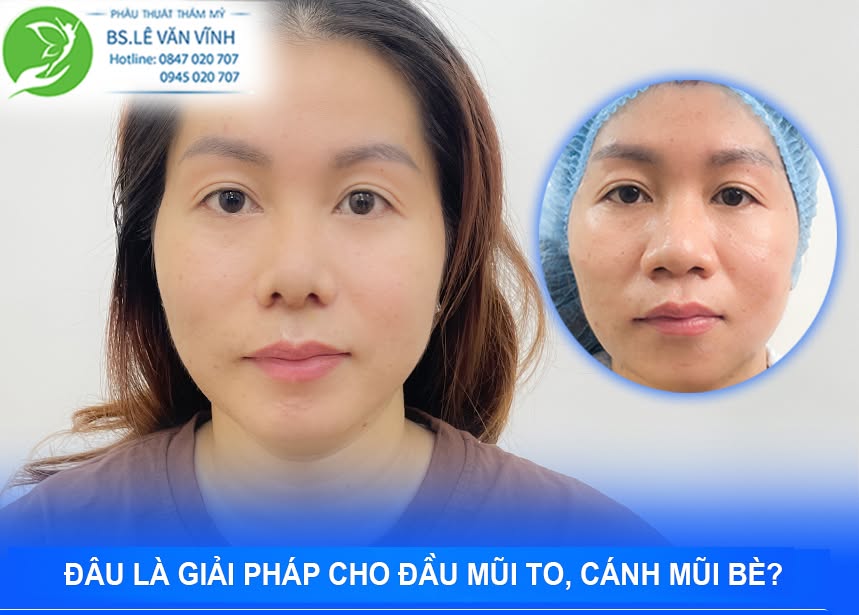 Thu gọn đầu mũi, cánh mũi do Bác sĩ Lê Văn Vĩnh thực hiện