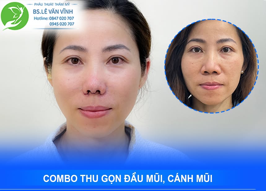 Thu gọn đầu mũi, cánh mũi do Bác sĩ Lê Văn Vĩnh thực hiện