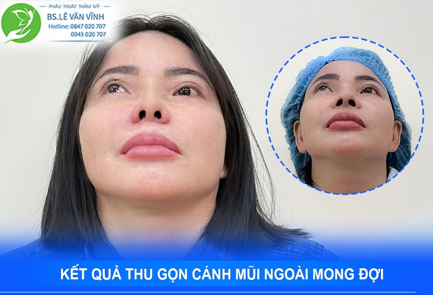 Cuộn cánh mũi do Bác sĩ Lê Văn Vĩnh thực hiện