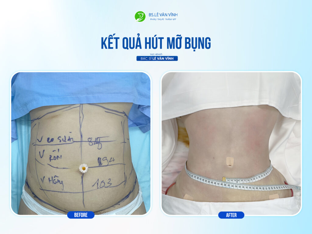 Kết quả hút mỡ bụng- Về dáng nhanh hơn trên cùng một lộ trình.
