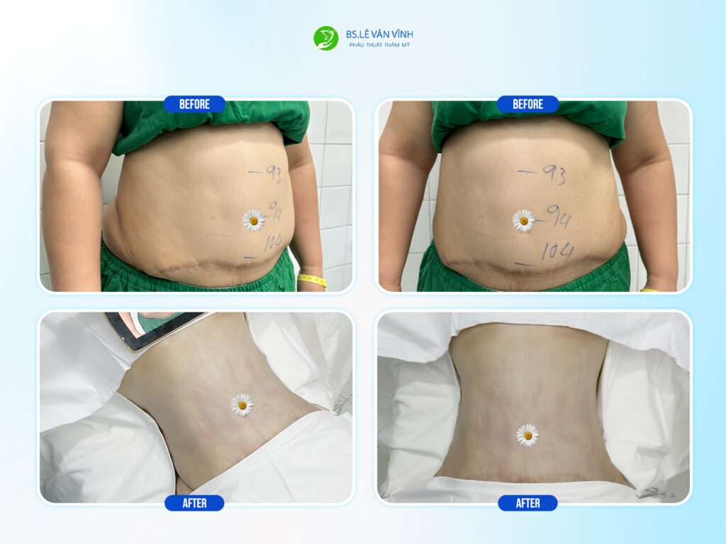 Kết quả hút mỡ bụng- Về dáng nhanh hơn trên cùng một lộ trình.