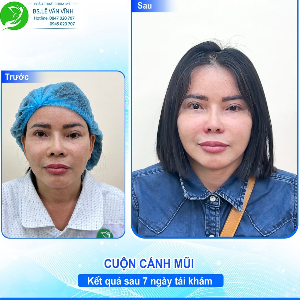 Cuộn cánh mũi do Bác sĩ Lê Văn Vĩnh thực hiện