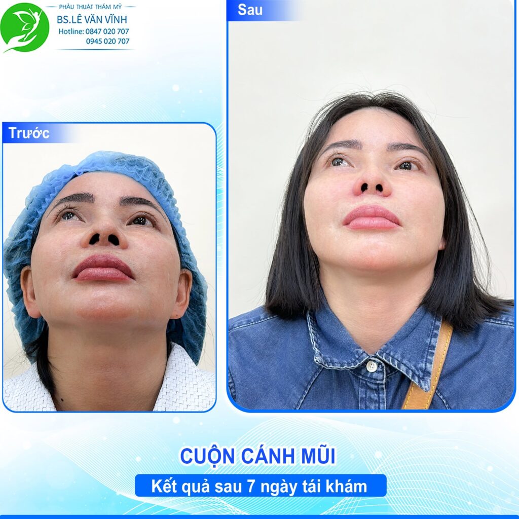 Cuộn cánh mũi do Bác sĩ Lê Văn Vĩnh thực hiện