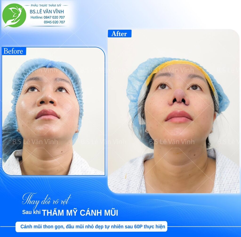 Cuộn cánh mũi do Bác sĩ Lê Văn Vĩnh thực hiện