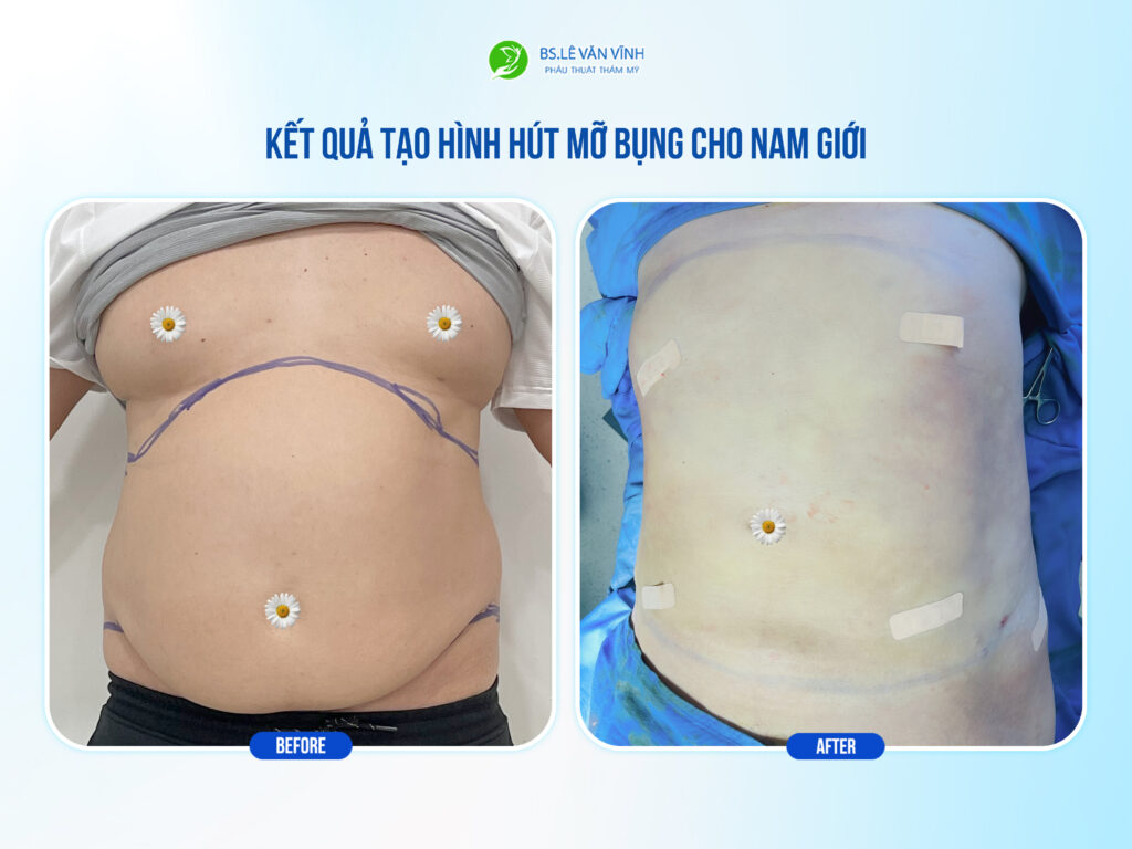 Kết quả hút mỡ bụng- Về dáng nhanh hơn trên cùng một lộ trình.