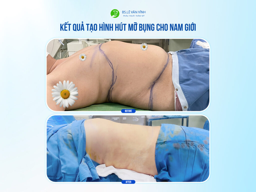 Kết quả hút mỡ bụng- Về dáng nhanh hơn trên cùng một lộ trình.
