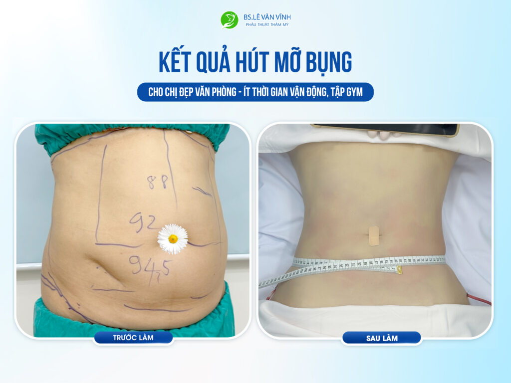 Kết quả hút mỡ bụng- Về dáng nhanh hơn trên cùng một lộ trình.