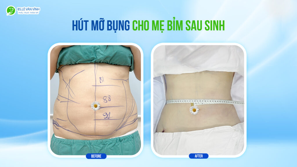 Kết quả hút mỡ bụng- Về dáng nhanh hơn trên cùng một lộ trình.