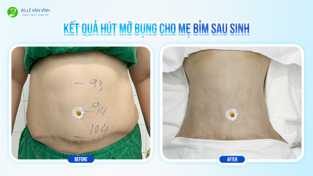 Kết quả hút mỡ bụng- Về dáng nhanh hơn trên cùng một lộ trình.