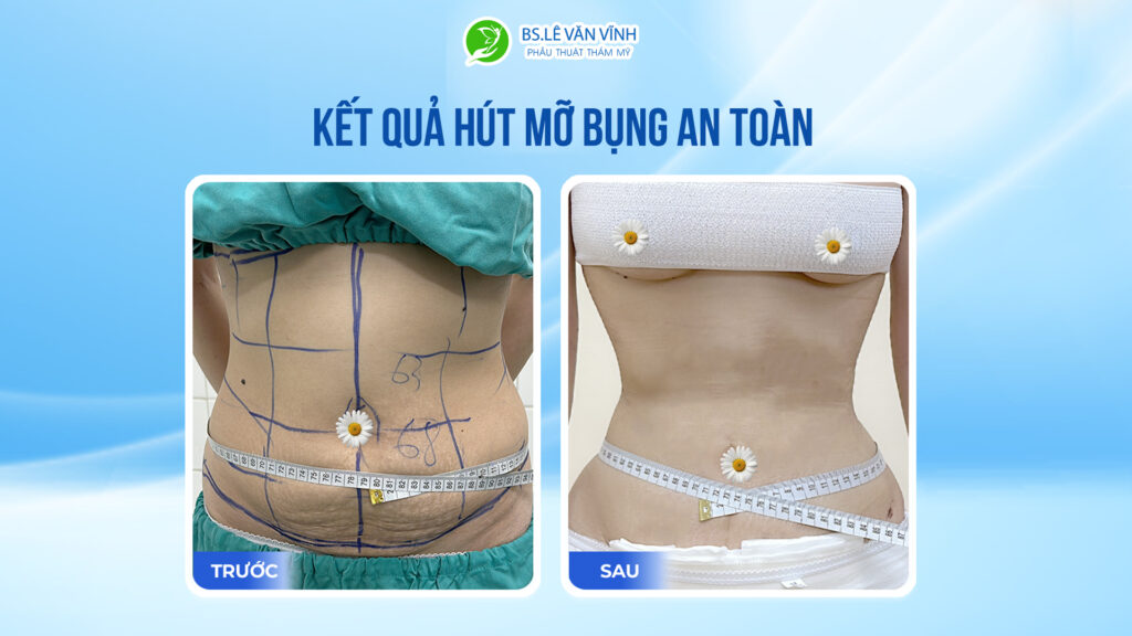 Kết quả hút mỡ bụng- Về dáng nhanh hơn trên cùng một lộ trình.