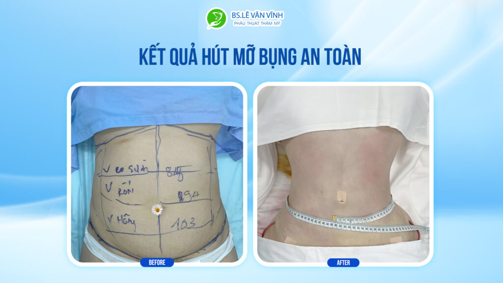 Kết quả hút mỡ bụng- Về dáng nhanh hơn trên cùng một lộ trình.