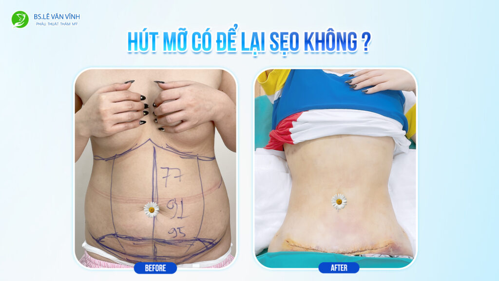 Kết quả hút mỡ bụng- Về dáng nhanh hơn trên cùng một lộ trình.
