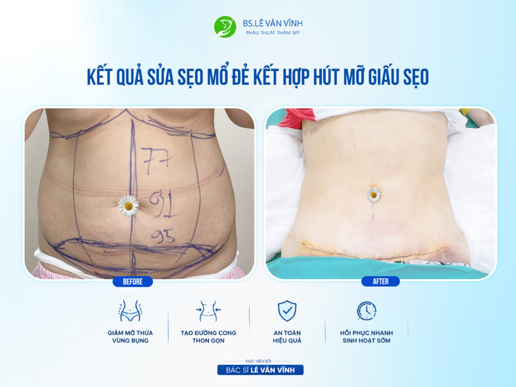 Kết quả hút mỡ bụng- Về dáng nhanh hơn trên cùng một lộ trình.