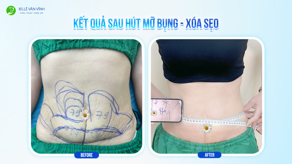 Kết quả Hút mỡ bụng - Xóa sẹo trên cùng một lộ trình.