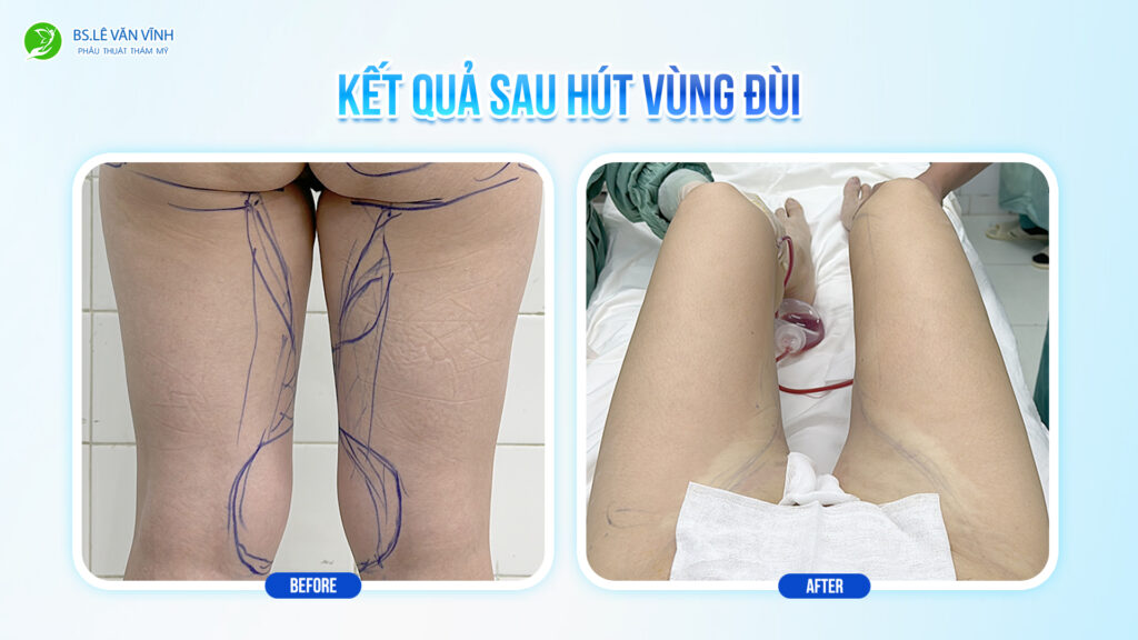 Kết quả hút mỡ đùi - Đôi chân trở nên thon thả sau một lộ trình.