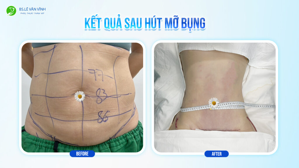 Kết quả hút mỡ bụng- Về dáng nhanh hơn trên cùng một lộ trình.