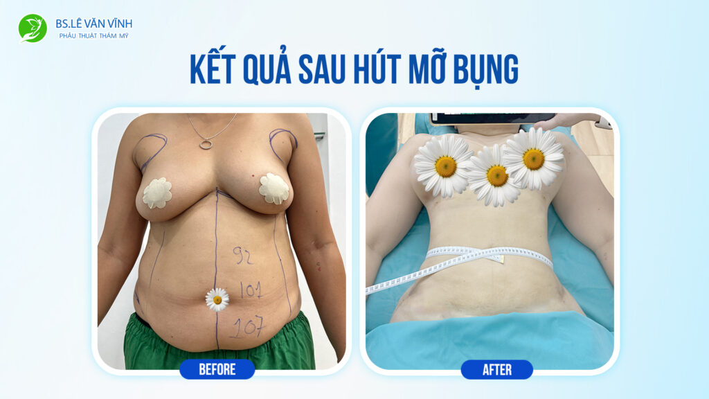 Kết quả hút mỡ bụng- Về dáng nhanh hơn trên cùng một lộ trình.