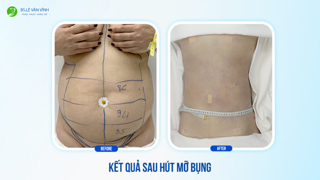 Kết quả hút mỡ bụng- Về dáng nhanh hơn trên cùng một lộ trình.