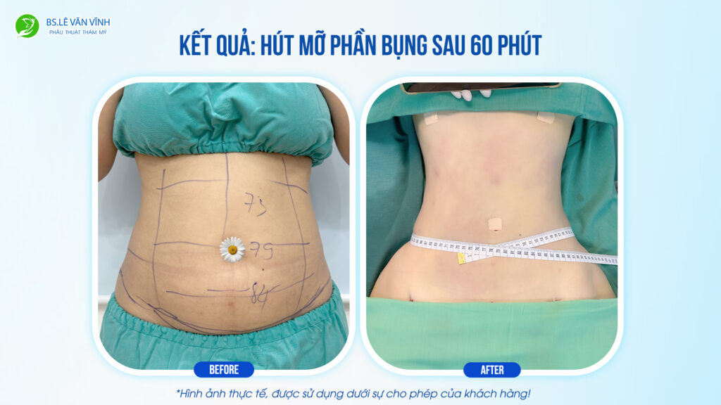 Kết quả hút mỡ bụng- Về dáng nhanh hơn trên cùng một lộ trình.